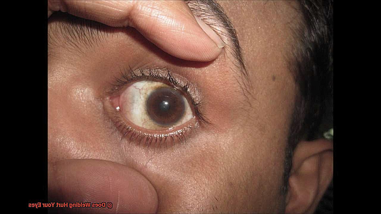 Does Welding Hurt Your Eyes-4
